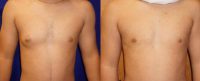 18-24 year old man treated with Male Breast Reduction for unilateral gynecomastia