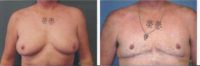 18-24 year old man treated with FTM Chest Masculinization Surgery