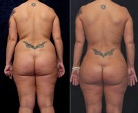 Dr Douglas L. Gervais, MD, Minneapolis Plastic Surgeon - 41 Year Old Mommy Makeover