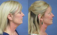 55-64 year old woman treated with Facelift to address loss of neck contour