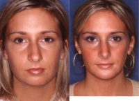 22 year old woman treated with Rhinoplasty and Chin Implant