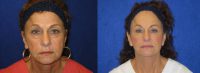 66 year old female had a facial rejuvenation