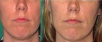 36  year old woman treated with Juvederm