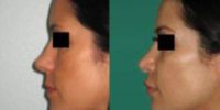 33  year old woman treated with Rhinoplasty