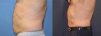 55-64 year old man treated with SculpSure 2 times in 1 year