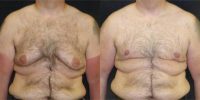 45-54 year old man treated with Male Breast Reduction