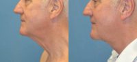 65-74 year old man treated with Direct Excision Neck Lift