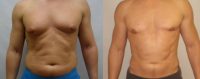 Male treated with Male Breast Reduction and Liposuction