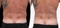 Male liposuction "love handles" with body-jet (water liposuction)
