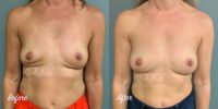 Fat Grafting to Breasts- 45-54 year old woman