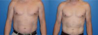 45-54 year old man treated with Liposuction of abdomen and flanks