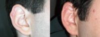 Man with congenital ear deformity