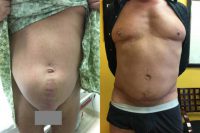 35-44 year old man treated with Hernia Repair