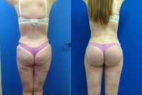 Buttock Implants with fat grafting