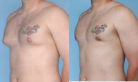 26 Year Old Male treated with Liposuction for Gynecomastia