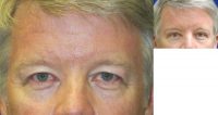 57 year old male with upper blepharoplasty and endoscopic browlift