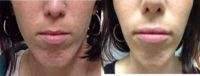 29 year old woman treated with Lip Augmentation