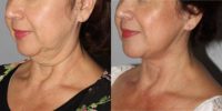 55 year old female treated with MACS face lift and full neck lift after massive weight loss.