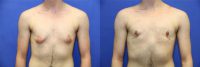 19 year old transgender man treated with FTM Chest Masculinization Surgery