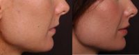 Perma Facial Lip implants creating balance to upper & lower lips