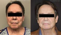 55-64 year old man treated with Renuvion