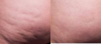 Woman treated with Cellfina - results after one year