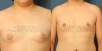 Man treated with Male Breast Reduction
