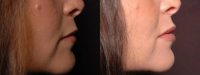 Perma Facial Lip implants creating balance to upper & lower lips