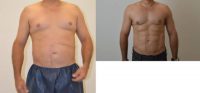 VASER Hi-Definition Liposuction of Abdomen and Flanks