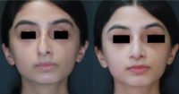 17 or under year old woman treated with Septoplasty