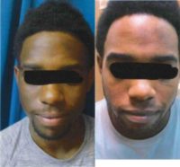 18-24 year old man treated with Skin Lightening ZO Skin Health products