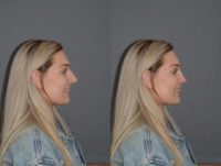 20 year old woman treated with Rhinoplasty