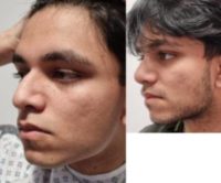 18-24 year old man treated with Rhinoplasty