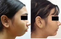 18-24 year old woman treated for Chin Surgery