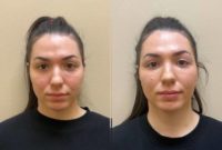 25-34 year old woman treated with Dermal Fillers, Cheek Lift
