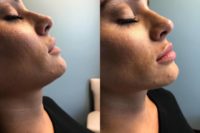 25-34 year old woman treated with Dermal Fillers