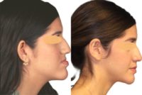 25-34 year old woman treated with Jaw Surgery