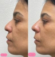 25-34 year old woman treated with Thread Lift, Nonsurgical Nose Job