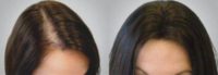 25-34 year old woman treated with PRP Injections( Hair Loss )