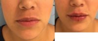 25-34 year old woman treated with Restylane Silk