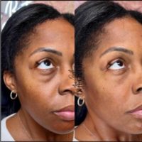 35-44 year old woman treated with Dermal Fillers, Cheek Fillers