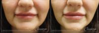 35-44 Year Old Woman Treated With Juvederm Volbella (Lips)
