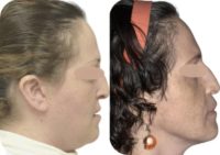 35-44 year old woman treated with Jaw Surgery