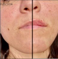 35-44 year old woman treated with Dermal Fillers, Lip Fillers