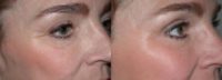 35-44 year old woman treated with Chemical Peel and Blepharoplasty
