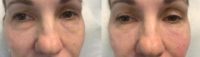 45-54 year old woman treated with Injectable Fillers