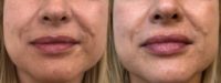 45-54 year old woman treated with Lip Fillers