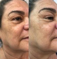 45-54 year old woman treated with Facial