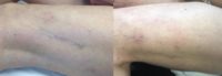 50 year old woman treated with ND:YAG laser for leg veins