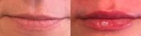 45-54 year old woman lip injections with Restylane